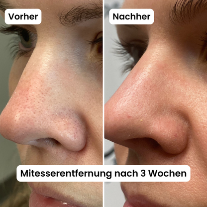 Poren-Reset-Serum (Reis Peeling)