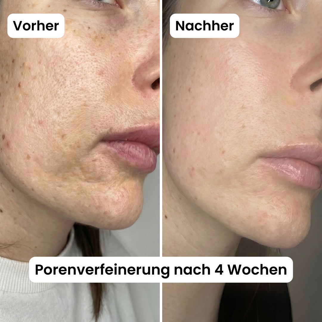 Poren-Reset-Serum (Reis Peeling)